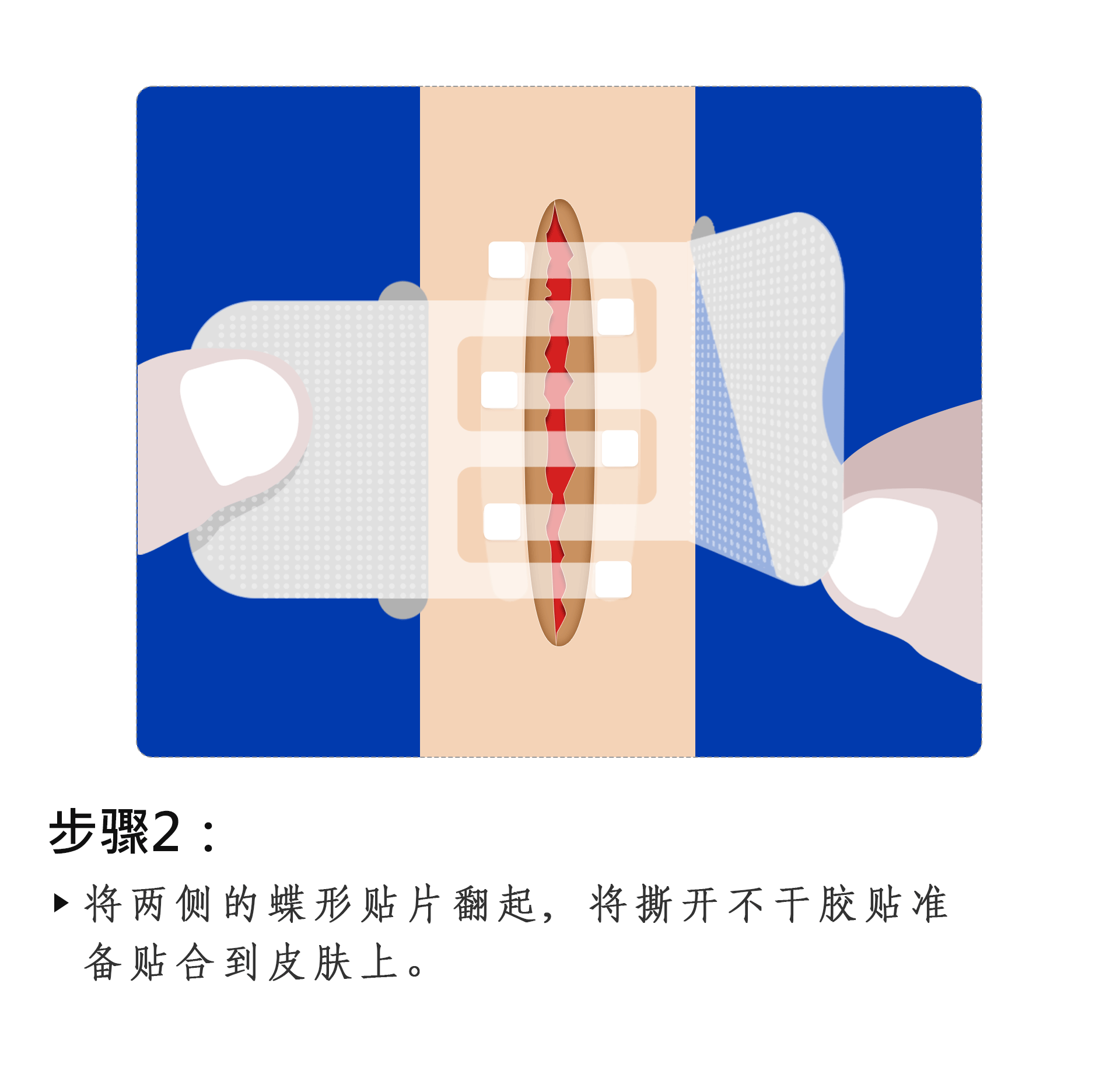蝶合伤口免缝针创可贴使用说明